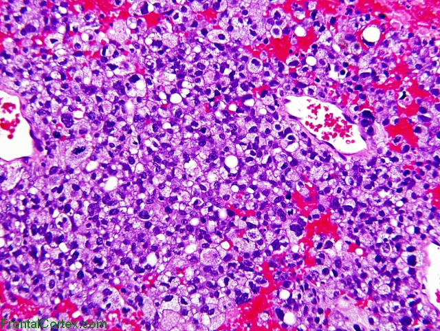 Metastatic carcinoma, H&E stained section x 100